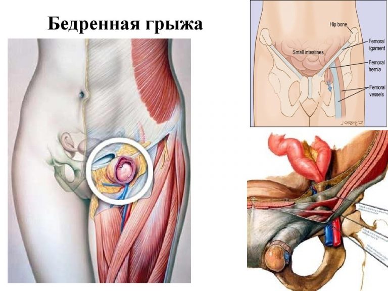 Пластика бедренной грыжи: преимущества лапароскопических методик