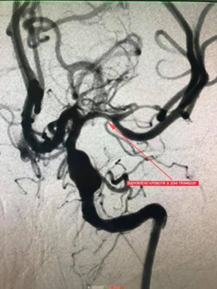 Франківські медики врятували життя молодій дівчині, в якої стався інсульт ФОТО та ВІДЕО