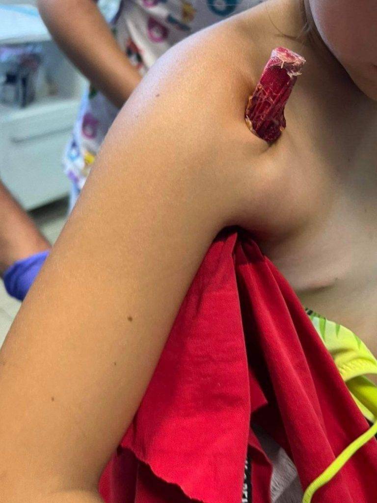 Арматура пройшла наскрізь: у Франківську дівчинка травмувалася на будівельному майданчику