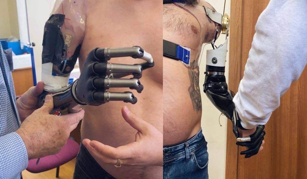 У міській лікарні Франківська військовослужбовців навчають користуватися протезами