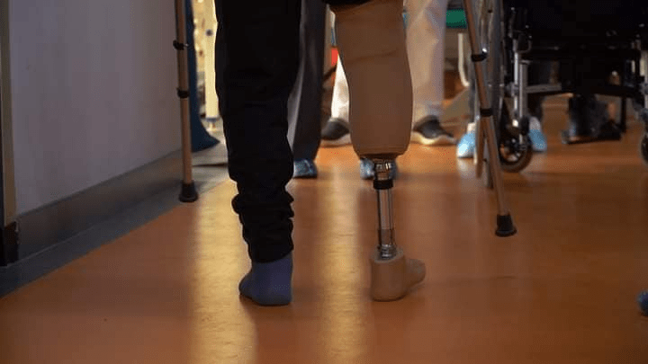 Франківські медики вперше протезували пораненого на фронті бійця