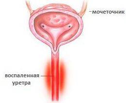 Как лечить неспецифический уретрит?