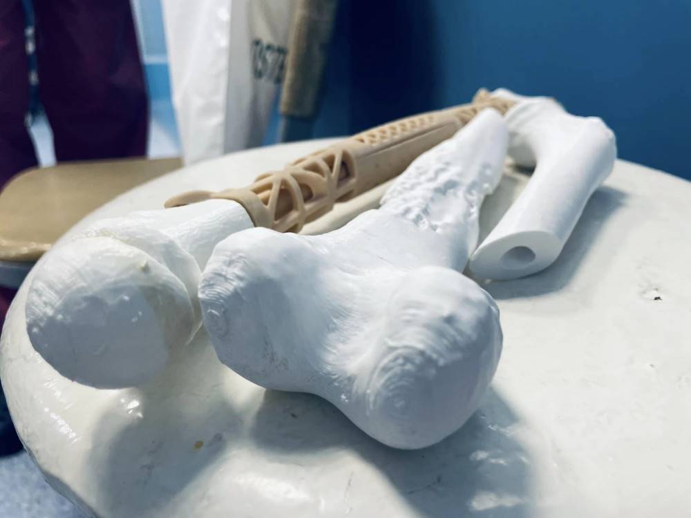 Восьмирічному хлопчику з Прикарпаття пересадили кістку, надруковану на 3D-принтері. ФОТО