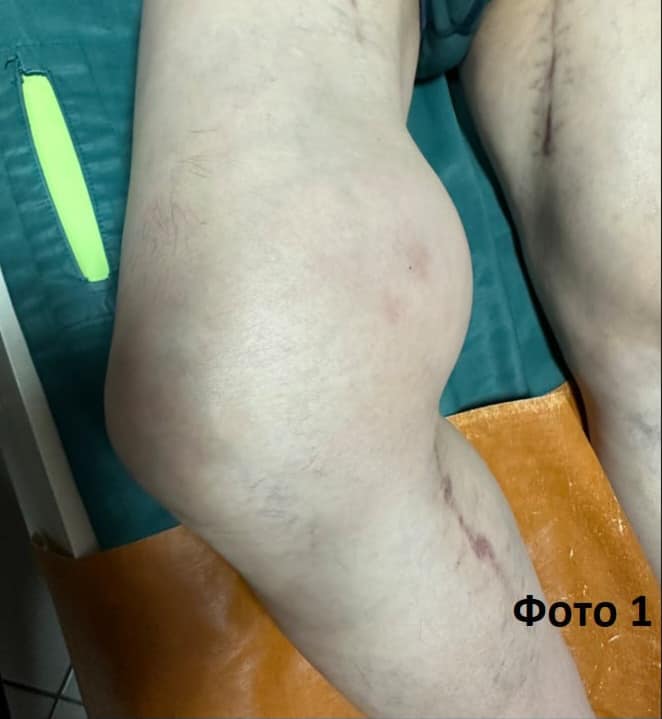 Урятували ногу від ампутації: франківські хірурги видалили пацієнту гігантську аневризму