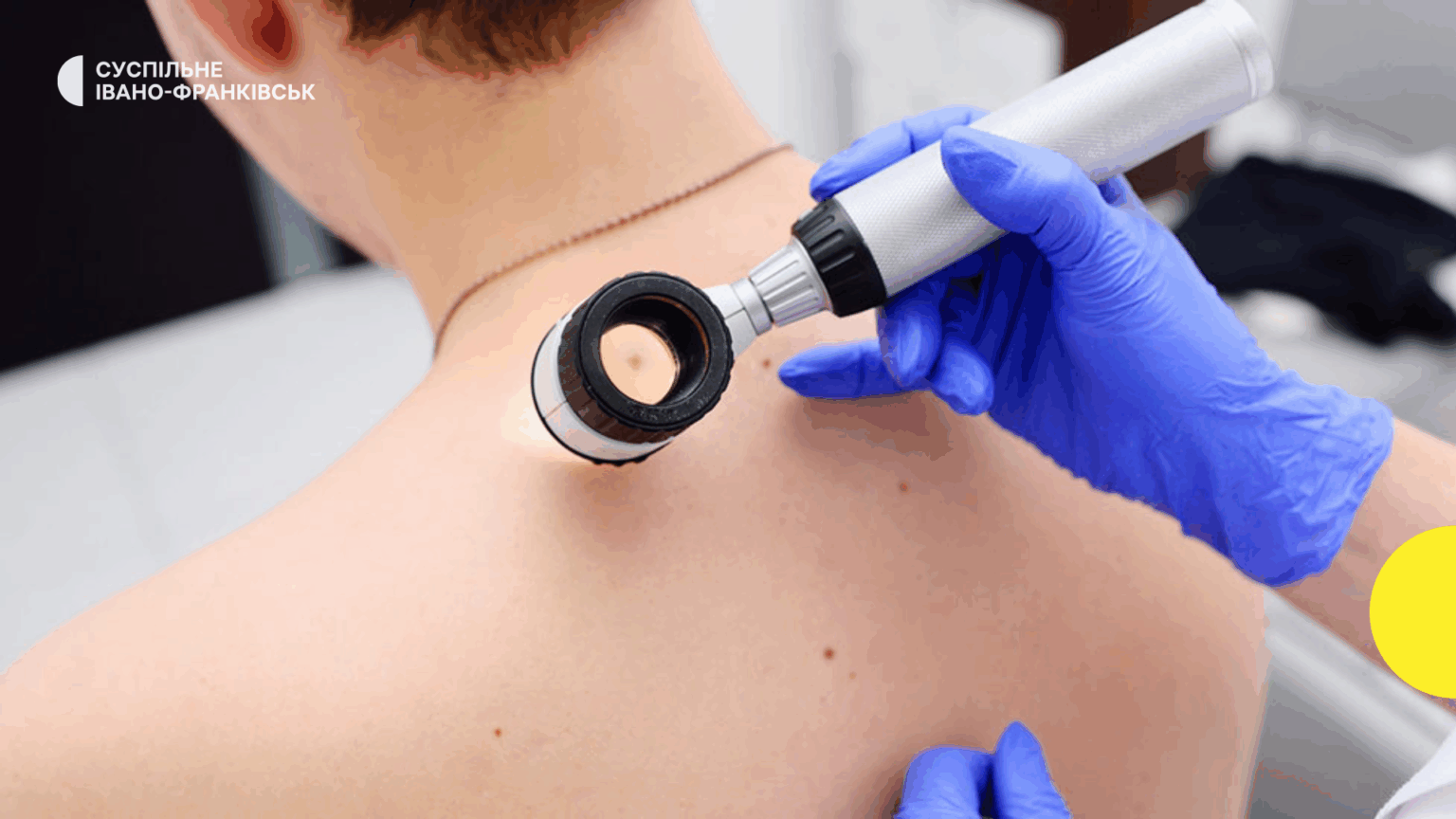Скільки людей померли від раку шкіри на Івано-Франківщині