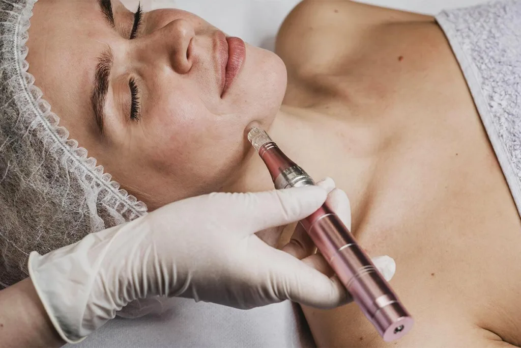 Мікронідлінг обличчя в косметологічному салоні