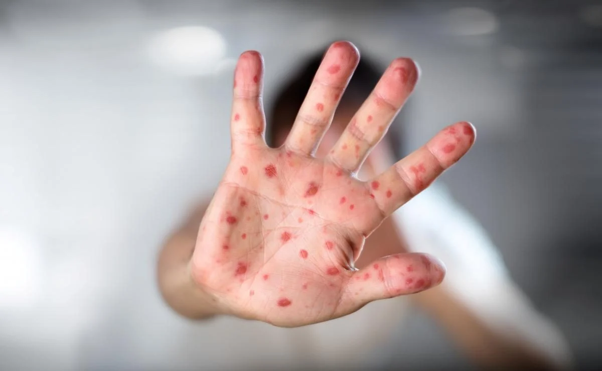 Рука з червоними плямами висипу