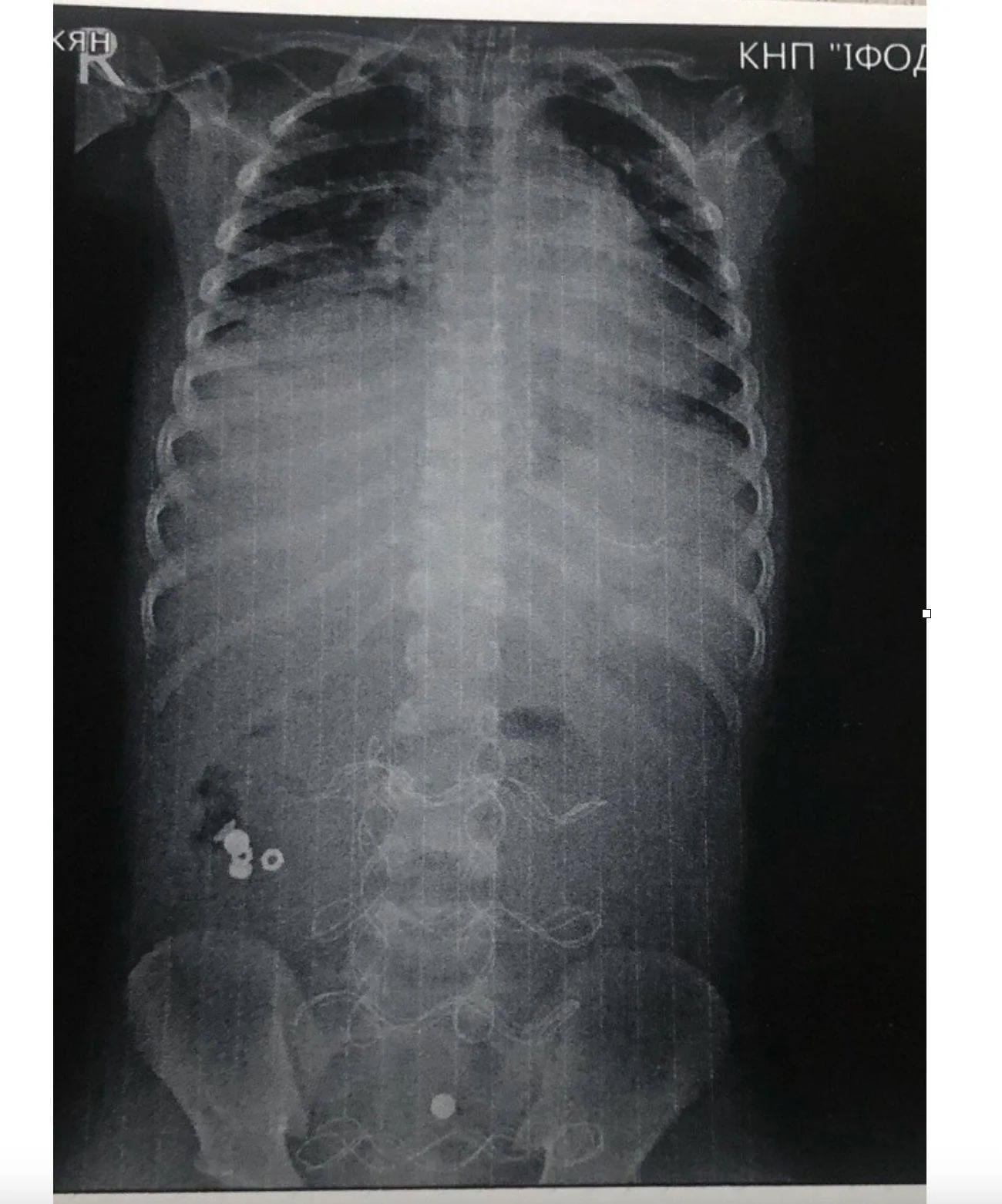 Рентген зображення грудної клітки та живота людини