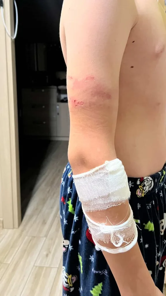 Подряпини та перев'язана рука дитини