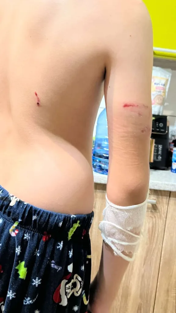 Дитина з подряпинами на руці та спині