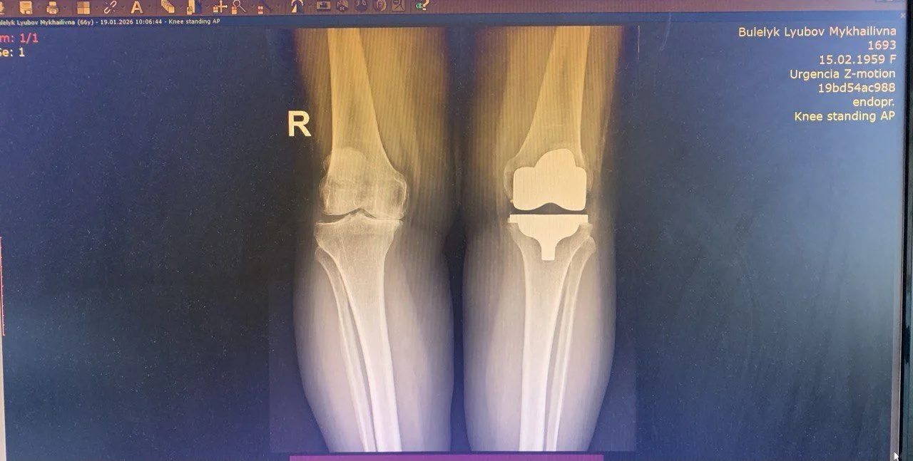 Рентген колінного суглоба з ендопротезом
