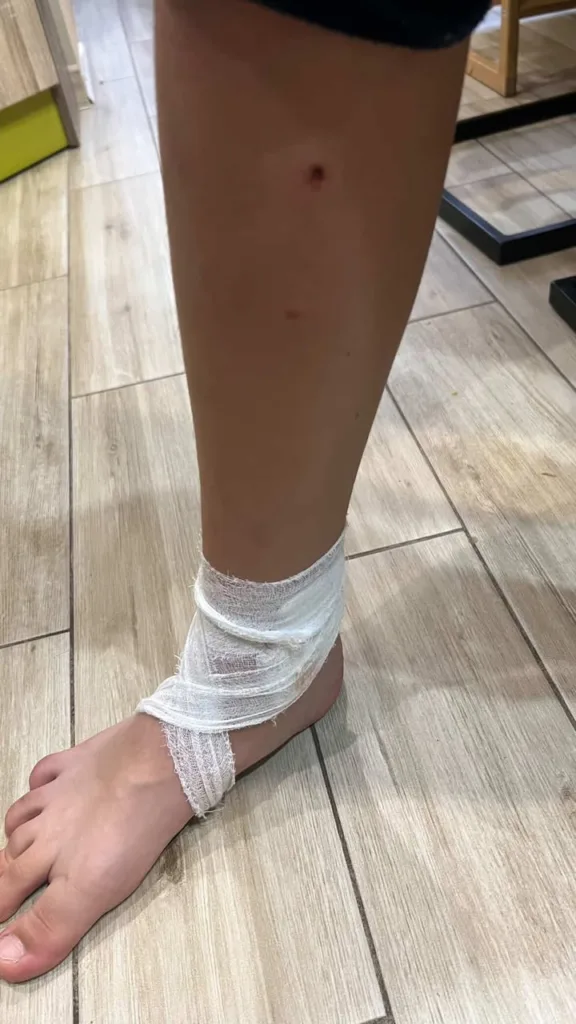 Нога з перев’язаною щиколоткою після поранення