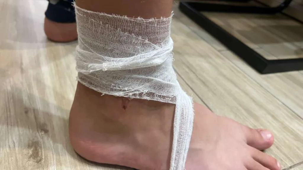 Поранена щиколотка, обмотана бинтом