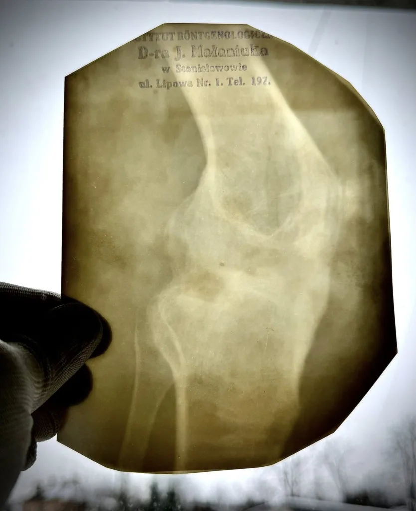 Старий рентгенівський знімок людської кістки
