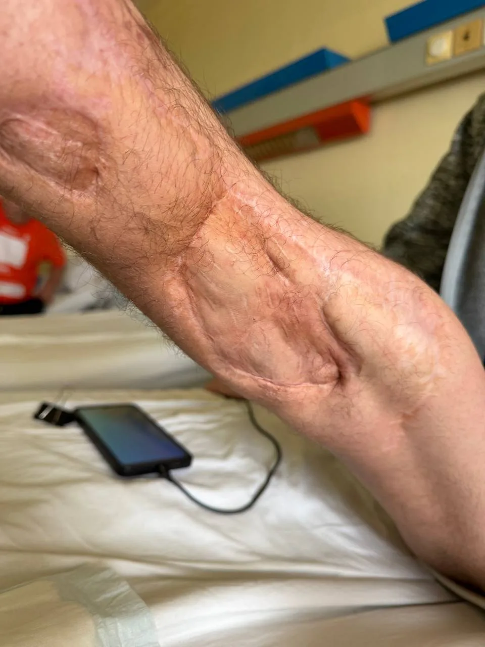 Рука з рубцями після опіків на ліжку