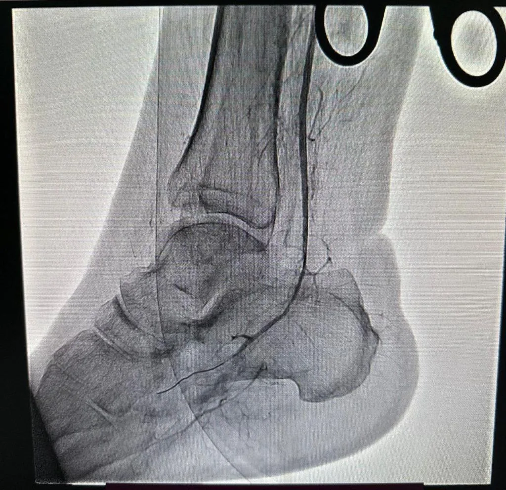 Рентген знімок щиколотки людини
