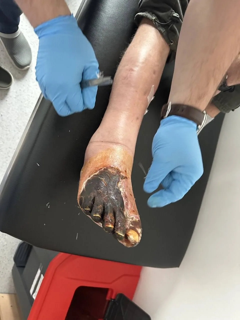 Медичне лікування ноги з важким опіком