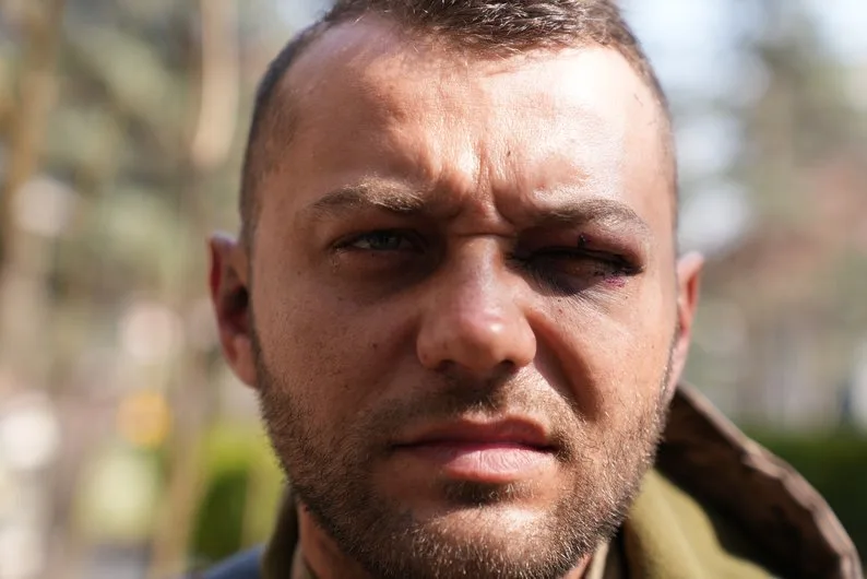 Чоловік із синцем під оком на вулиці