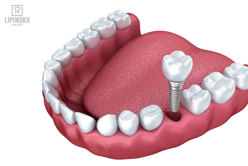 Схема зубного імпланта в нижній щелепі