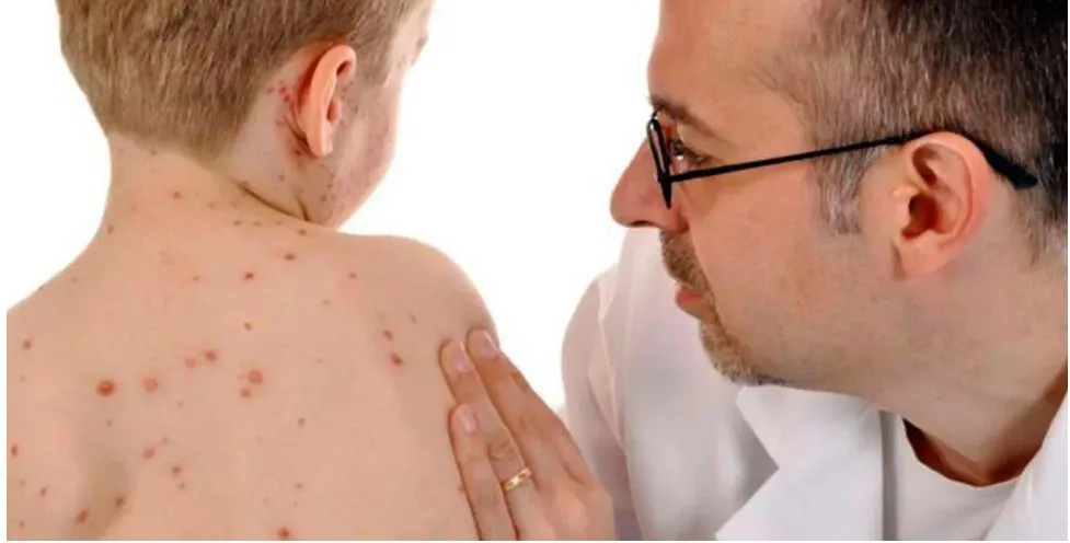 Лікар оглядає дитину з висипом на спині