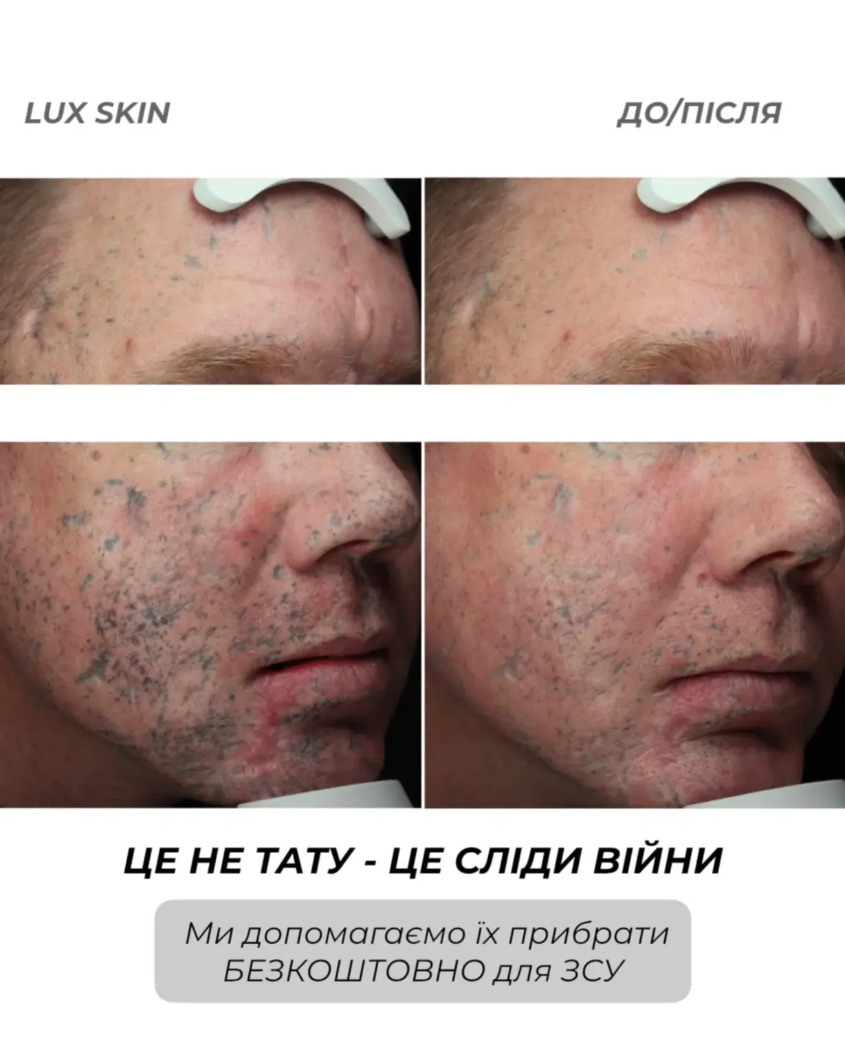 Видалення шрамів після війни безкоштовно для ЗСУ