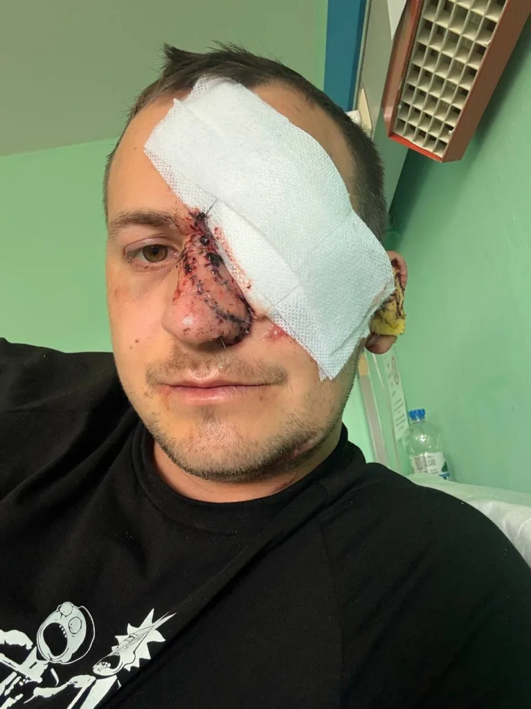 Чоловік із пов’язкою на пораненому обличчі