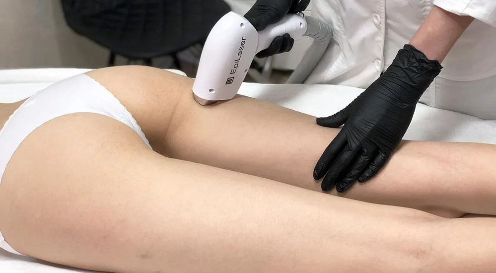 Лазерна епіляція ніг у косметологічному салоні